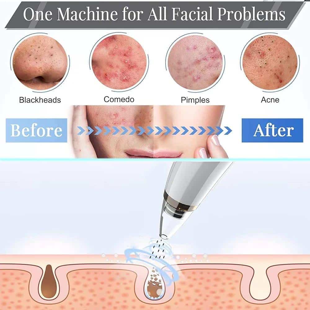 Electric Facial Vacuum Pore Cleaner | Hot Compress Blackhead Remover for Deep Cleansing & Acne Care